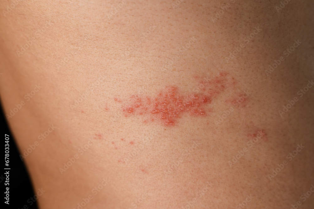 Man with shingles disease, skin infected with Herpes zoster, virus, Healthcare and medical. Man with shingles disease, skin infected with Herpes zoster, virus, Healthcare and medical.