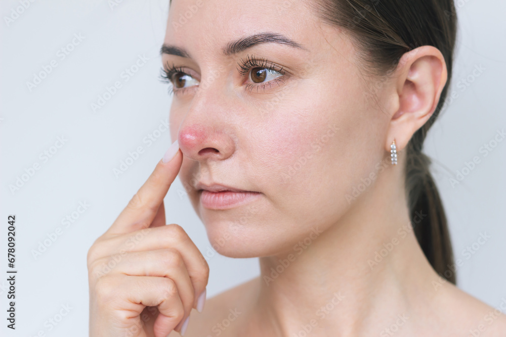 close-up of the face of a young dark-haired Caucasian woman pointing with her finger at a large red pimple on her nose. Dermatology, acne, problematic skin. close-up of the face of a young dark-haired Caucasian woman pointing with her finger at a large red pimple on her nose. Dermatology, acne, problematic skin.