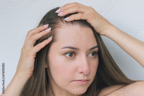 a young pretty Caucasian brunette woman suffering from hair loss spreads her hair in the temple area with both hands. baldness, the effects of the disease, lack of vitamins. Woman's health
