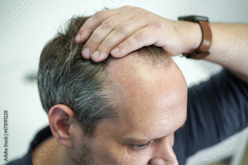 Baldness on the head of a middle-aged man. Hair loss.