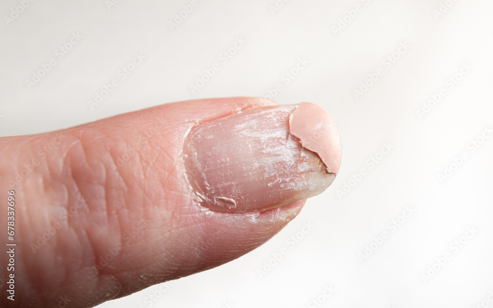 Close up view of layers peeling off damaged finger nail after UV nail polish usage. Home indoors. Close up view of layers peeling off damaged finger nail after UV nail polish usage. Home indoors.
