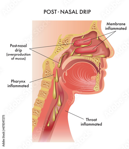 Medical illustration of symptoms of Post-Nasal Drip, with annotations.