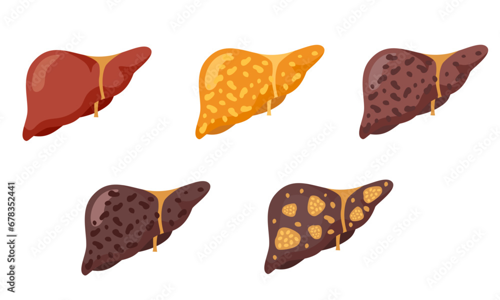 Set of flat vector illustrations on the theme of medicine. Stages of liver diseases. . Vector illustration