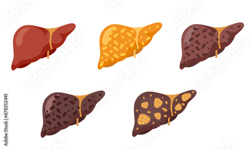 Set of flat vector illustrations on the theme of medicine. Stages of liver diseases. . Vector illustration