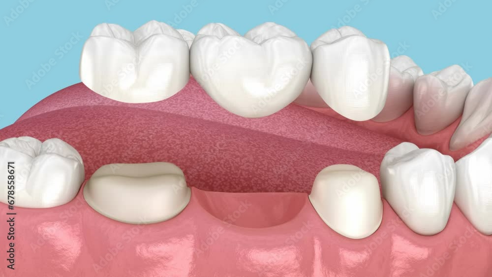 Dental bridge placement. 3D animation Dental bridge placement. 3D animation