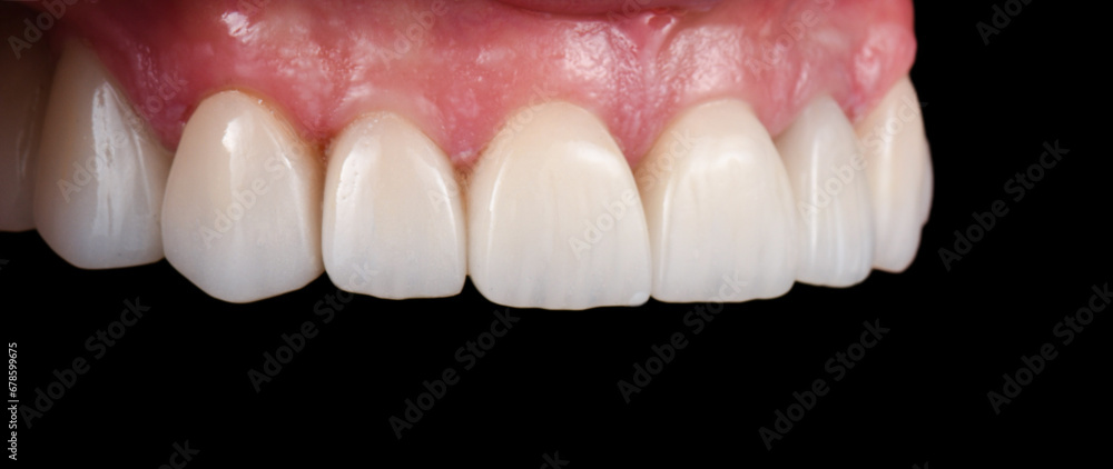 Emax crowns and veneers Emax crowns and veneers