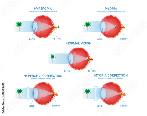 Vision defects visual impairment normal myopia hyperopia correction infographic scheme vector flat