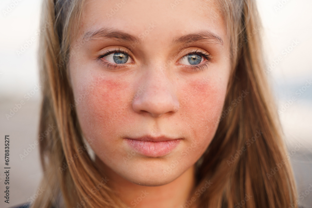 Portrait of a girl with a burnt face, sunburn. Beauty care from skin problem treatment Portrait of a girl with a burnt face, sunburn. Beauty care from skin problem treatment