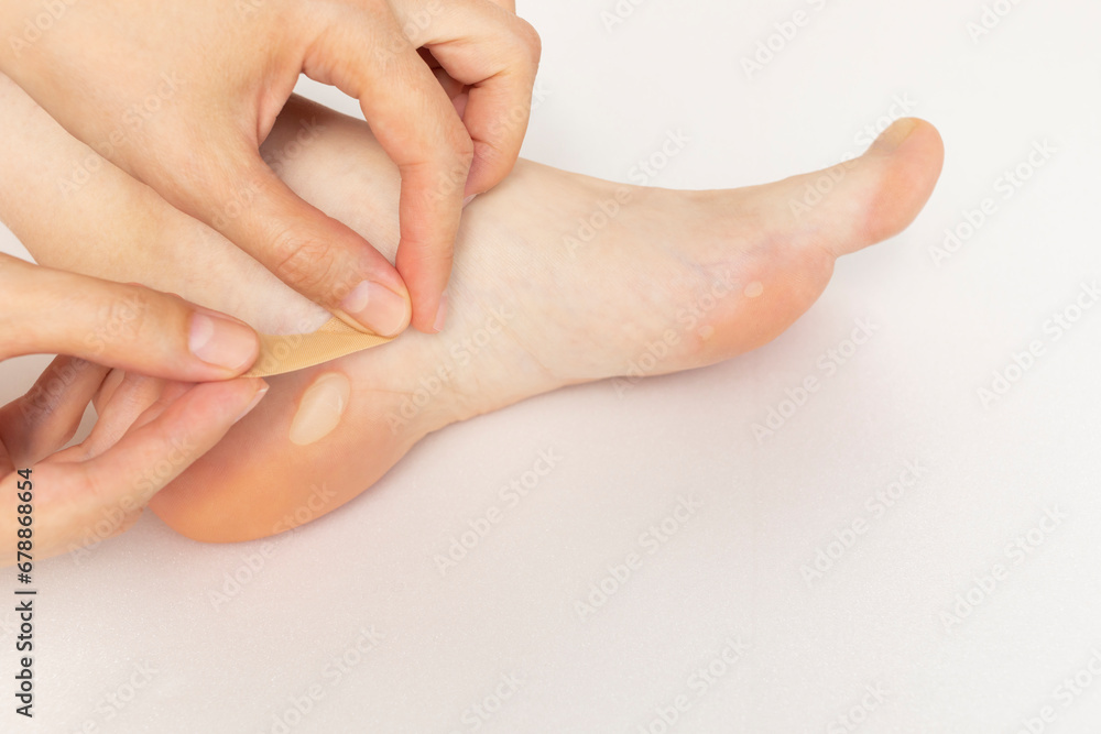 Person Applies Adhesive Plaster On Foot Calluses, Skin Corns on Heel and Phalange of Toe. Water Blister Disease On Feet. Painful Callosity Before Treatment. Closeup Horizontal Plane. Copy Space. - obrazy, fototapety, plakaty 