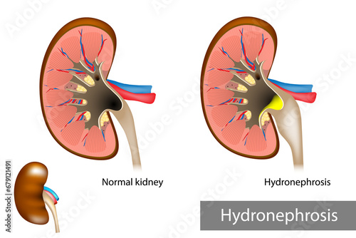 Hydronephrosis. Urinary Tract Dilation photo