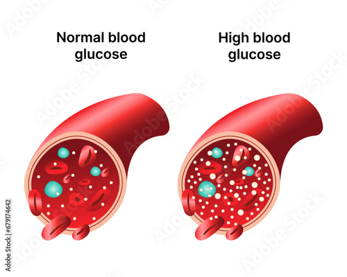 Diabetes disease biological vector illustration. Comparison of a healthy person and a person with diabetes. World Diabetes Day