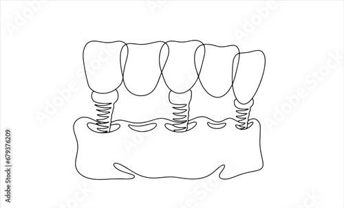 5 teeth. Dental bridge. One line