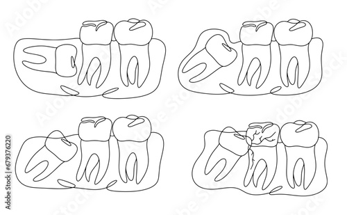 Wisdom tooth. Impacted tooth. Teeth. One line