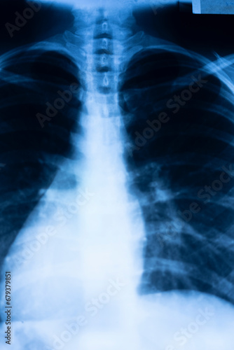 Lungs ribs xray scan © edwardolive