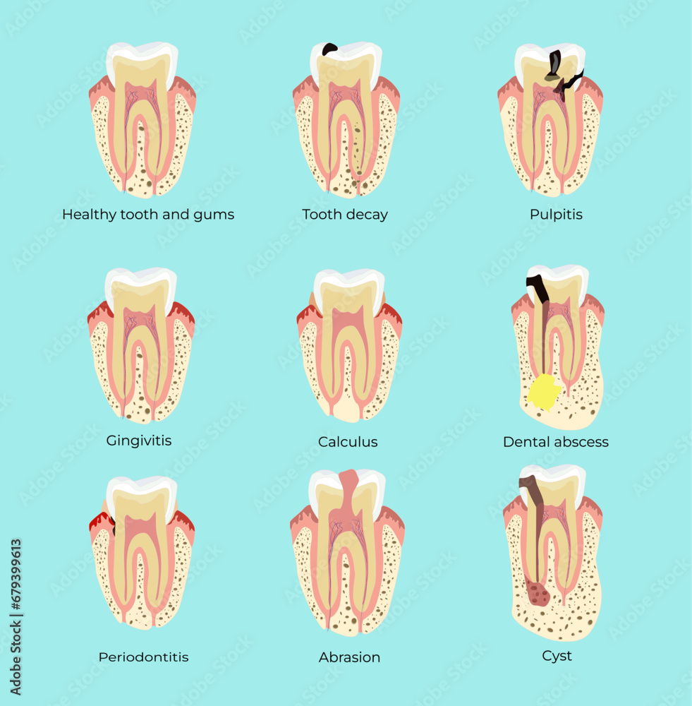 Dental diseases teeth caries pulpitis cyst gingivitis periodontitis ...