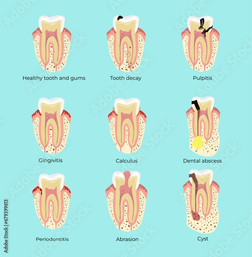 Dental diseases teeth caries pulpitis cyst gingivitis periodontitis. Medical illustration. Stomatology photo