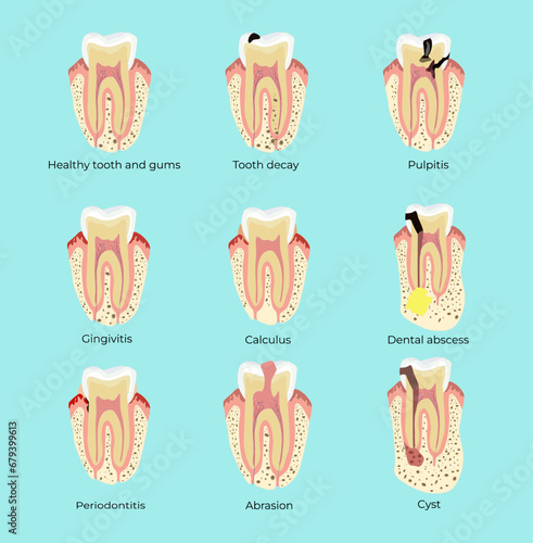 Dental diseases teeth caries pulpitis cyst gingivitis periodontitis. Medical illustration. Stomatology