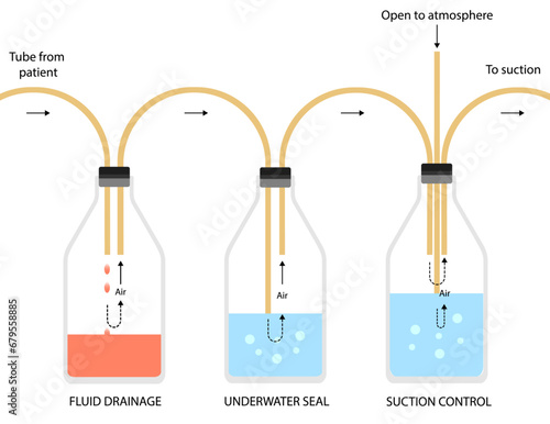 Three bottle system of chest tube insertion Tube thoracostomy Intercostal drainage ICD. Medical procedure vector illustration isolated on white background.
