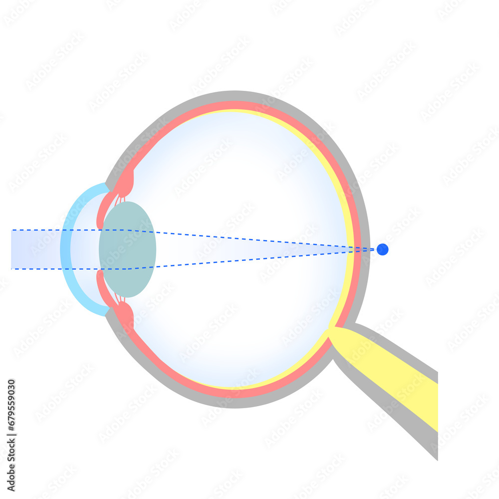 軸性遠視の眼球のイラスト 軸性遠視の眼球のイラスト