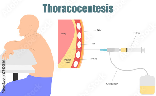 Thoracentesis procedure remove fluid  from around the pleural space. Can help diagnose such as Cancer Tuberculosis Empyema Pulmonary embolism Pancreatitis SLE CHF fungal. Medical procedure vector photo