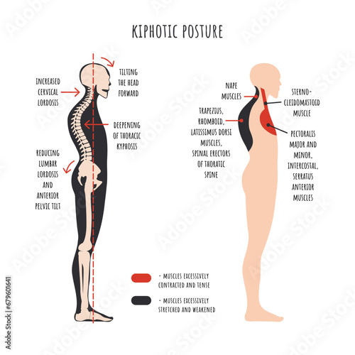 Posture disorders infographics. Kyphotic posture. The side view shows deformation of rounded shoulders, spine curvature, pelvis rotation, stretched and weakened, shortened and tens muscles. Vector.