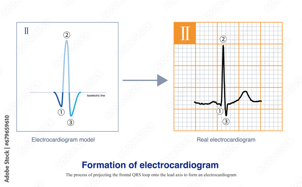 When A Planar Vectorcardiogram Is Projected Onto The Lead Axis, An 