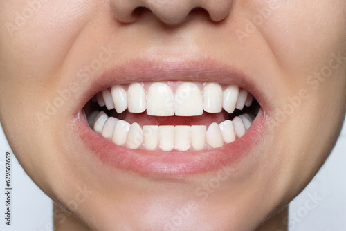 Woman's smile after teeth straightening and whitening. Ideal, beautiful shape of teeth on the upper and lower jaw after installing veneers or braces. Close-up. Patient at a dental orthodontic clinic.