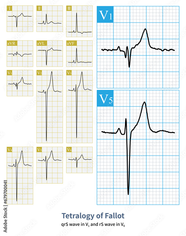 Male, 21 years old, clinically diagnosed with tetralogy of Fallot. The ...