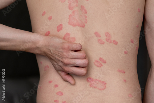 Psoriasis Vulgaris, skin patches are typically red, itchy, and scaly. Papules of chronic psoriasis vulgaris on male hand, back and body. Genetic immune disease. Detail of psoriatic skin disease  photo