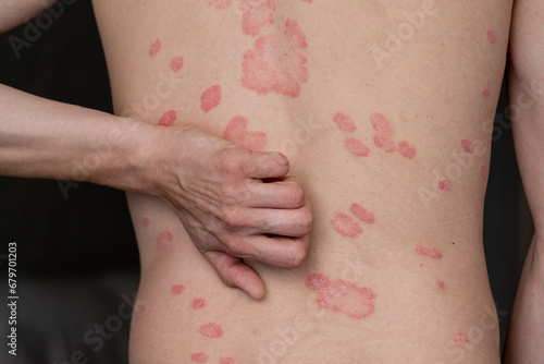 Принти на полотні Psoriasis Vulgaris, skin patches are typically red, itchy, and scaly