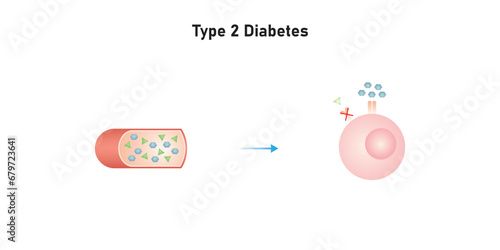 Type 2 Diabetes Scientific Design. Vector Illustration.