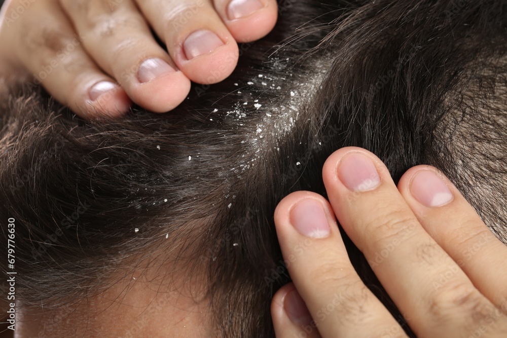 Man with dandruff in his dark hair, macro view Man with dandruff in his dark hair, macro view