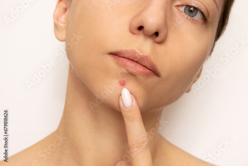 Close-up portrait of a young beautiful woman pointing at a large inflamed purulent pimple on her chin. Facial skin problems  acne. Hormonal disbalance. Cosmetology and dermatology. Beauty and care
