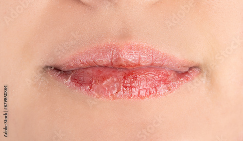 Dried and chapped  female lips