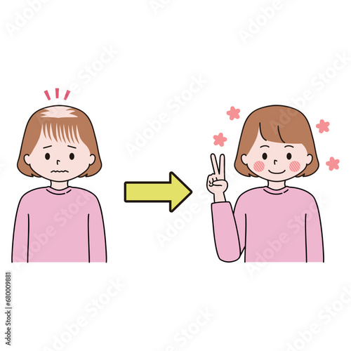 FAGA　頭頂部と前髪の薄毛の治療に成功した女性　ピース