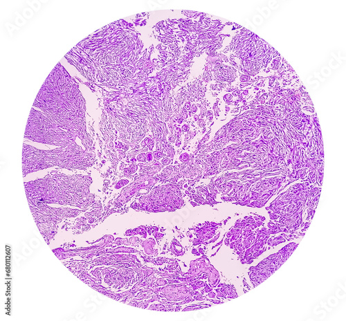 Photomicrograph: Meningioma, the most common type of primary brain tumor