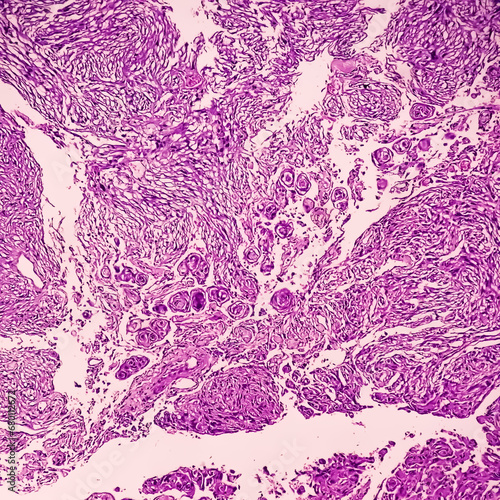 Fototapet Photomicrograph: Meningioma, the most common type of primary brain tumor