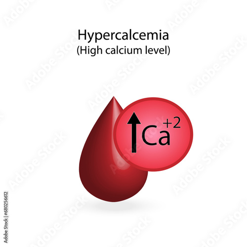 Hypercalcemia, high plasma calcium level. Calcium excess and deficit electrolyte disorders, blood droplet, Scientific design. Vector illustration.	
