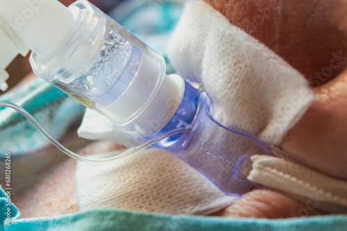 Closeup view of patient with tracheostomy. 
