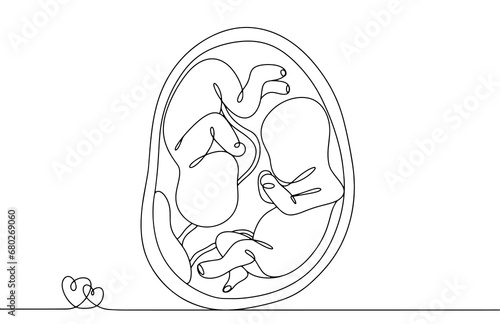 Pregnancy. Twins. Monozygotic. One line