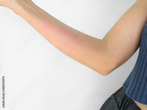 Woman with Urticaria on Skin Hand Non-Lethal Type from Food and Air Poisoning Health,Medicine Body Care Disease Lilness Air,She Apply Calamine Red Lotion Treatment on Arm Body,Infection Pain sickness. photo
