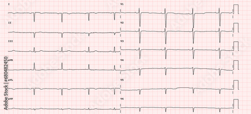 Fotografie ECG example of  right axial deviation of the heart 12-lead rhythm