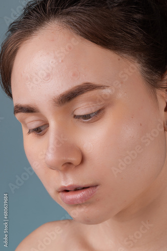 Girl with acne stick round acne patch on her cheek. Using acne patches for treatment of pimple and rosacea close-up. Facial rejuvenation cleansing cosmetology photo