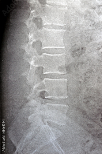 Plain X ray lumbosacral spine revealed straightened, mild scoliotic deformity of  lumber spine, spondylotic changes, bilateral Sacroiliitis, mild narrowing of L4-L5, L5- S1 disc spaces photo