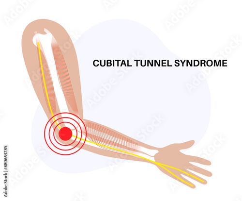 Cubital tunnel syndrome
