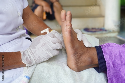 Approach diabetes foot common diabetic foot disorder with monofilament , medical equipment. © Kumphaitoon
