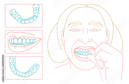 Orthodontic silicone trainer. Invisible braces aligner poster.