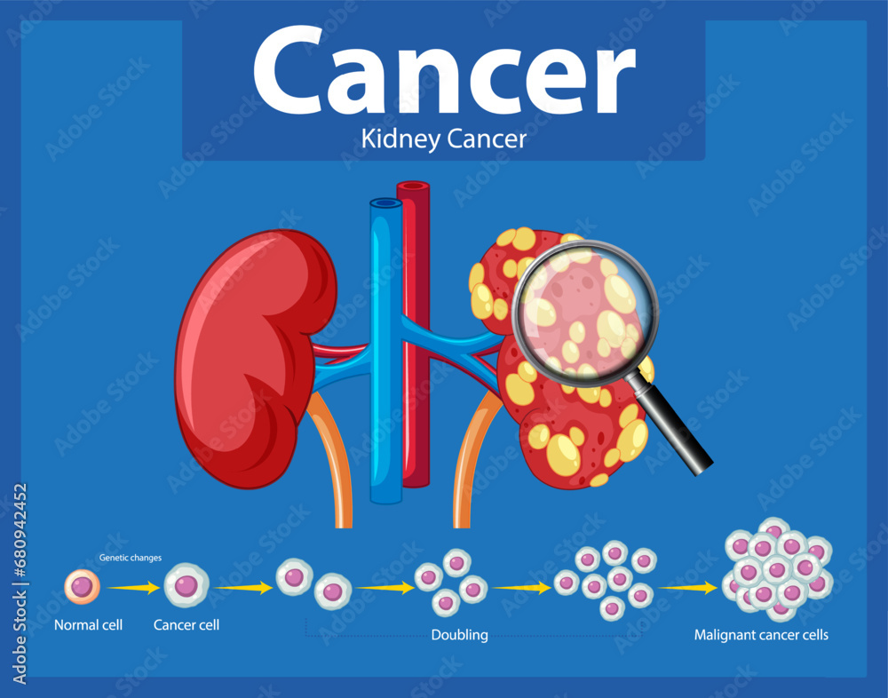 Cancer Development Process in Human Kidney: An Infographic