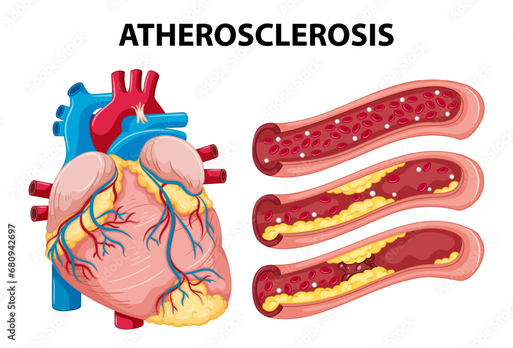 Science Education on Human Anatomy and Atherosclerosis Development - obrazy, fototapety, plakaty 