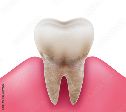 Unhealthy dirty teeth with a lot of tartar and plaque causing tooth decay. Isolated on a white background. Realistic vector illustration.